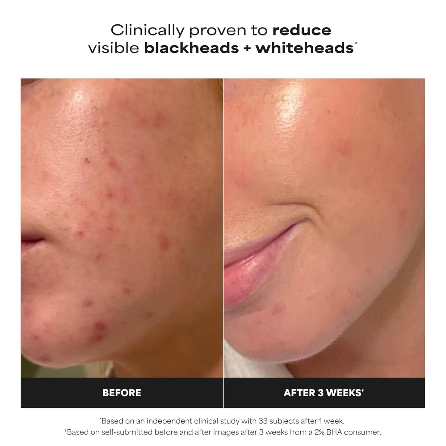 Paula's Choice SKIN PERFECTING 2% BHA Liquid