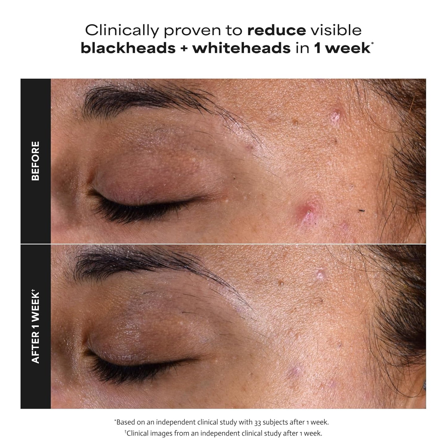 Paula's Choice SKIN PERFECTING 2% BHA Liquid